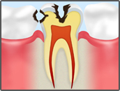 歯の内側の虫歯