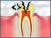 歯の神経の虫歯