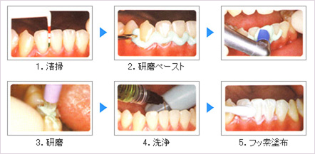 歯のクリーニングPMTC