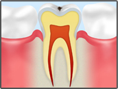 ごく初期の虫歯
