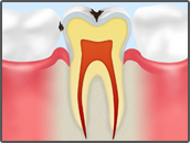 歯の表面の虫歯