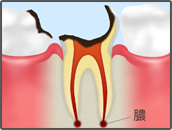 末期の虫歯
