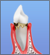 初期の歯周病